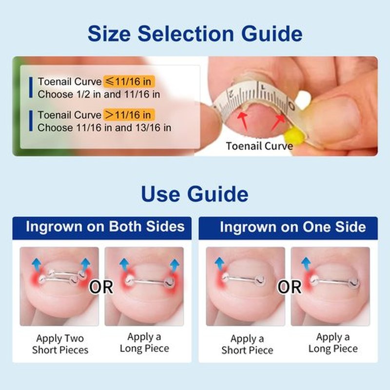 Nitinol Ingrown Toenail Corrector,at Home Ingrown Toenail Treatment,Curved Toenail Straightener,Ingrown Toe Nail Relief，Ingrown Toenail Removal Kit (1/2 In,11/16 In)