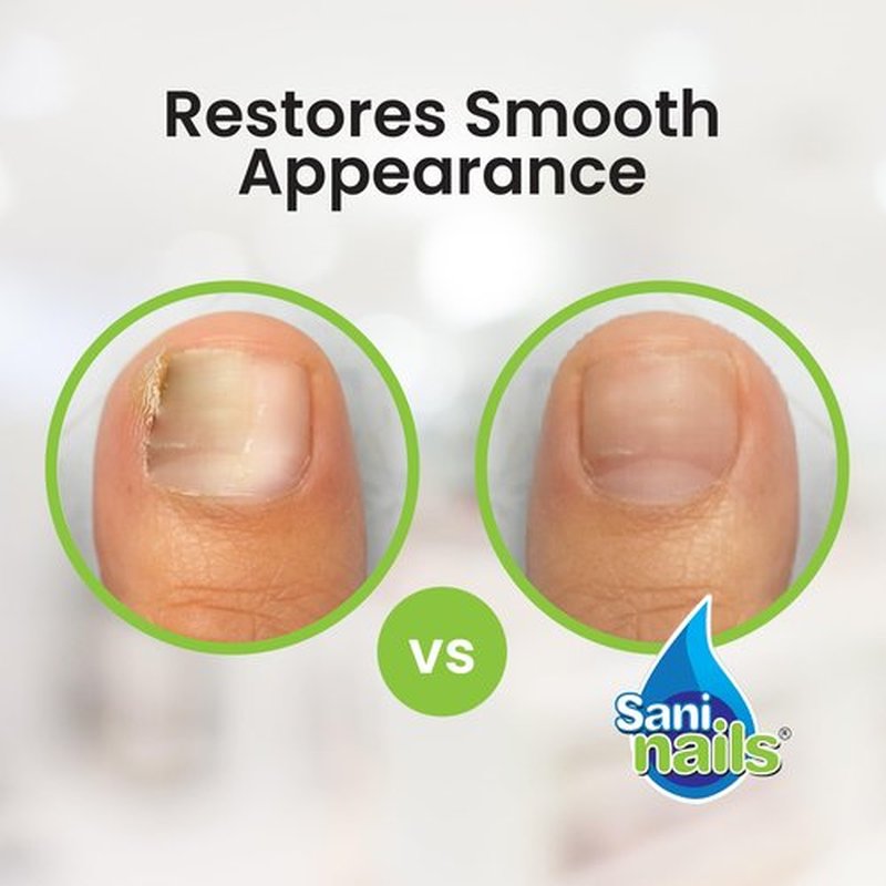 Troya Toenail Repair For Damaged Nails – Sani Nails Brush-On Toenail Solution for Hydrating and Restoring (1 Pack)