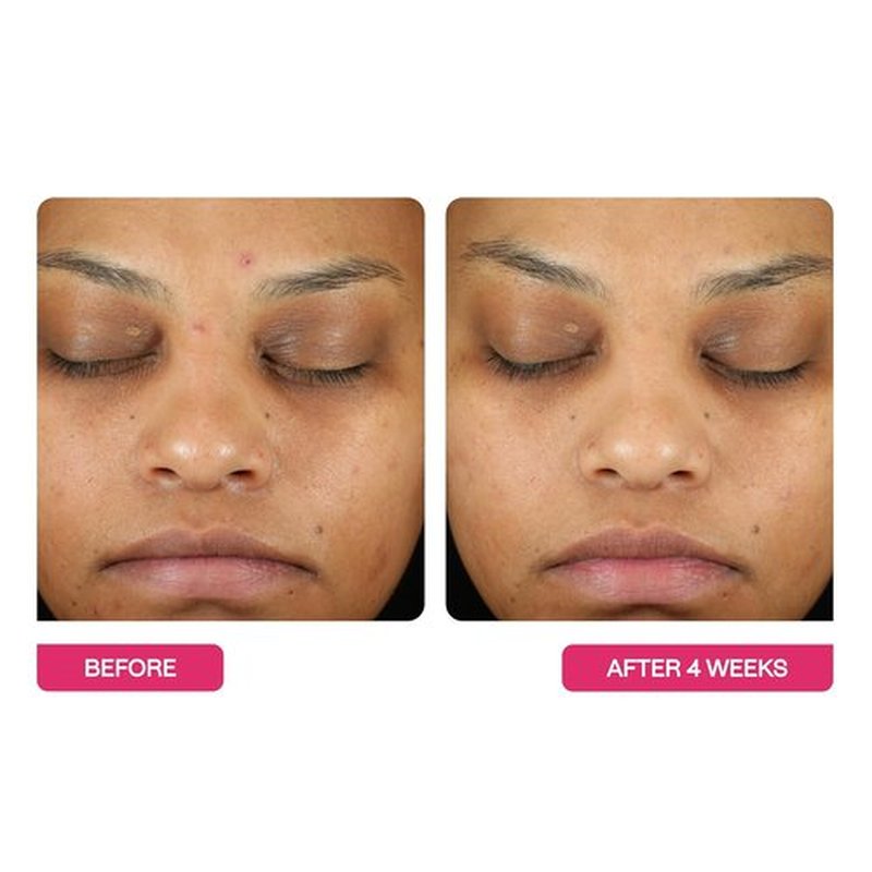 BeautyStat Triple Action Daily Exfoliating Peel Pad - Gentle AHA/BHA Treatment for Uneven Tone & Fine Lines