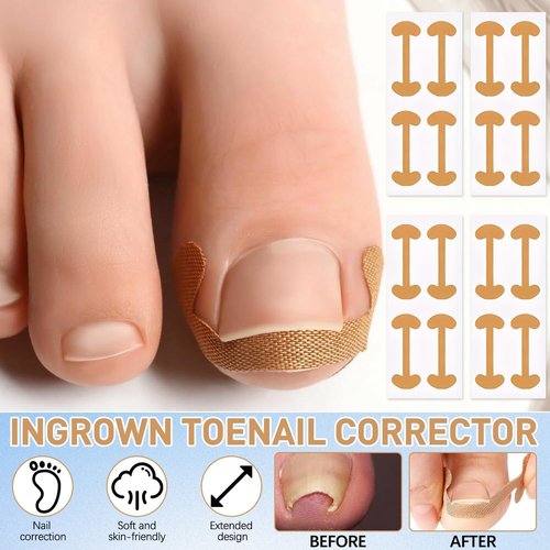 Ingrown Toenail Corrector Set with Correction Strips, Professional ingrown toenails pedicure tool set for men and women (1 SET)