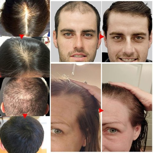 Aceite de Romero para Crecimiento y Tratamiento Capilar, Gotero para Estimular el Crecimiento del Cabello y Prevenir la Caída, 60ML/2.2 Fl Oz (2 Unidades)