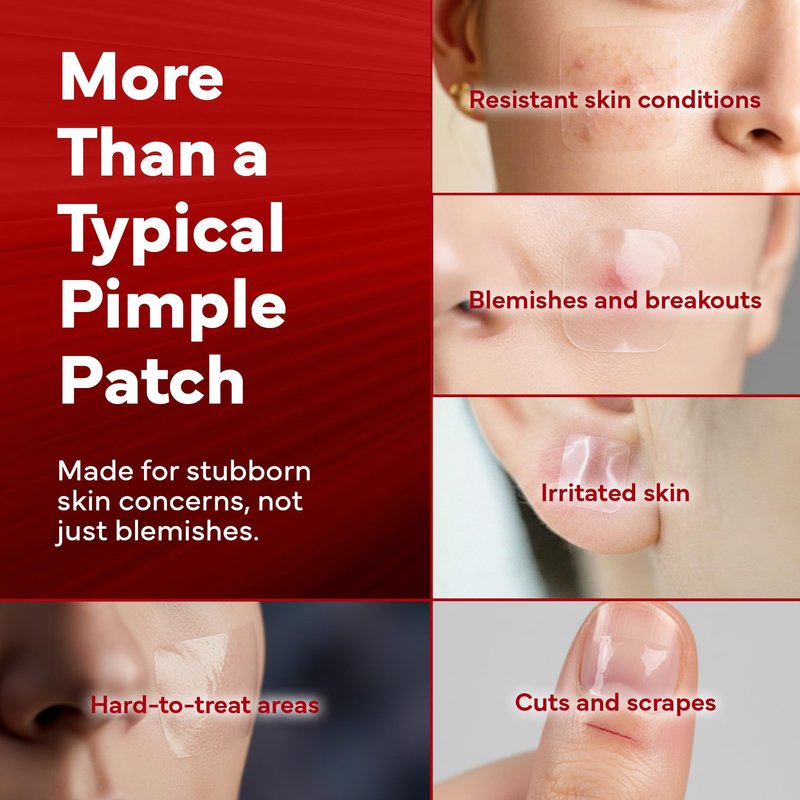 emuaid EMUAIDMAX Hydrocolloid Acne Patches, Pimple Spot Treatment, Hydrocolloid Invisible Pimple Patches for Covering Blemishes and also Treats Warts, Skin Tags, Cold Sores and Eczema,12 Count