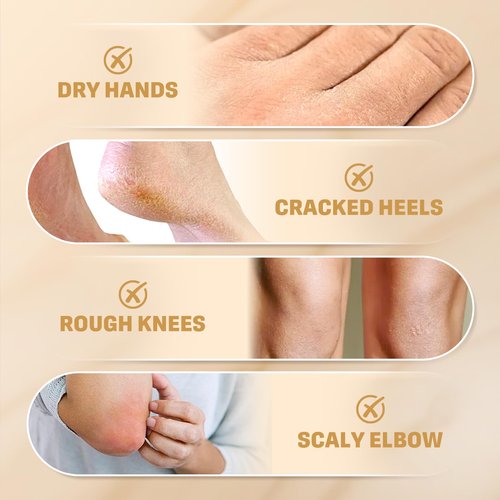 Clyecfra 40% Urea Cream with 2% Salicylic Acid, Urea Cream 40 Percent for Feet & Hands- Maximum Strength Moisturizer for Rough, Dry, Thick & Cracked Skin, Callus Remover, Deep Hydration, 150g