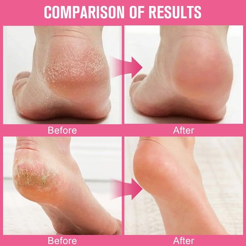 GHENGUA 2PCS 60% Urea Hydrating and Anti-Cracking Foot Cream，2025 Upgraded Hand and Foot Cream Urea Moisturizer，Hydrates Dry and Cracked Feet and Hand (1.41 Ounce, Peach)