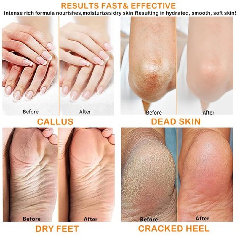 fenlebeneil 40% Urea Cream Cracked Heel Balm for Dry, Cracked Feet, Heals, Foot Hand Moisturizing 40 Percent Foot Urea Cream for Feet Maximum Strength 2Pack