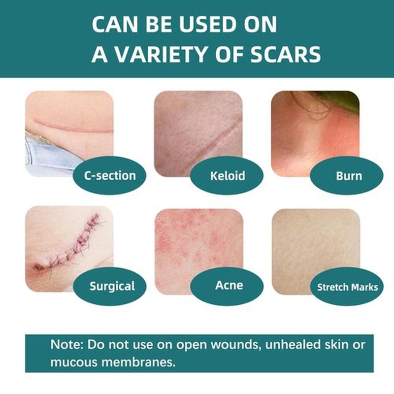 Silicone Scar Gel Sheets: Medical Grade Scar Tape for C Section Surgical Tummy Tuck Keloid Treatment–Scar Removal for Face and Skin