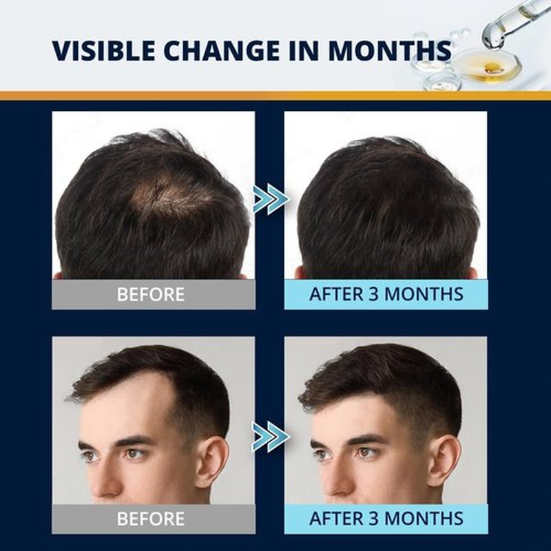 5% Minoxidil Hair and Beard Growth Kit: Extra Strength Minoxidil Topical Hair Regrowth Treatments Serum for Thinning Hair - Hair Loss Products for Men and Women