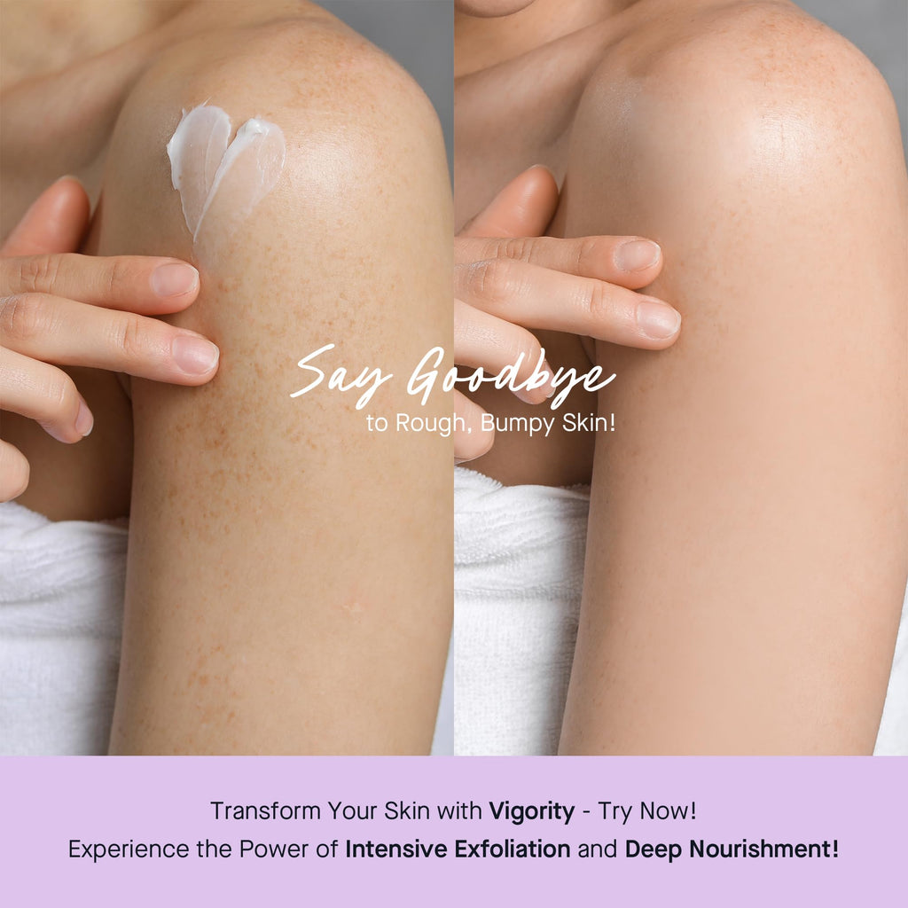 Vigority Keratosis Pilaris Treatment Cream with Lactic Acid – KP Body Bump Exfoliating Moisturizer for Rough, Bumpy, Dry & Flakey Skin, Strawberry Legs – 5.1 Oz