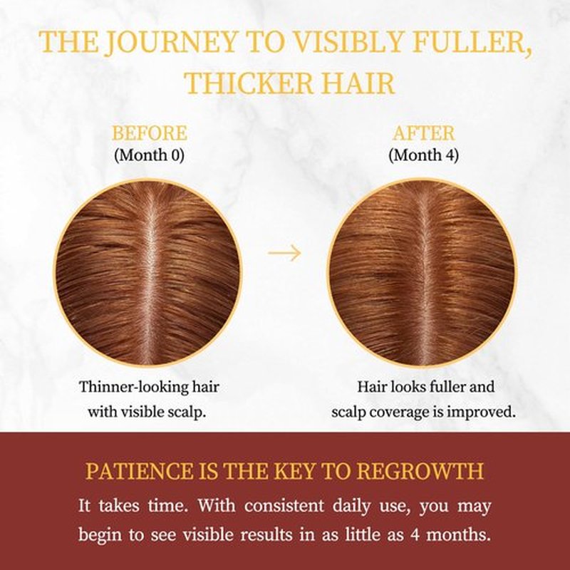 Minoxidil for Women Hair Growth with Biotin, Extra Strength Topical Minoxidil Serum Solution with Rosemary for Hair Regrowth Treatments, Non-Greasy, Helps Prevent Hair Thinning & Hair Loss