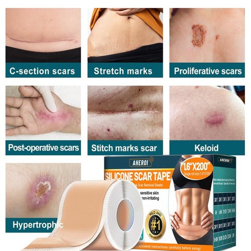 Aheroi Silicone Scar Tape, 1.6"x200" Silicone Scar Sheets(2 Rolls-5M)Medical Grade Scar Sheets for Surgical Scars, Soft Scar Patches Reusable Scar Removal Strips,Effective C-Section Keloid Tummy Treat