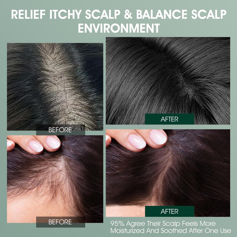 VOERUY Scalp Treatment, Rosemary Refreshing Scalp Treatment with Tea Tree, Clarifying Build Up & Purifying, Leave-In Scalp Detox for Dry Itchy Scalp,Vegan & Cruelty-Free,120ML