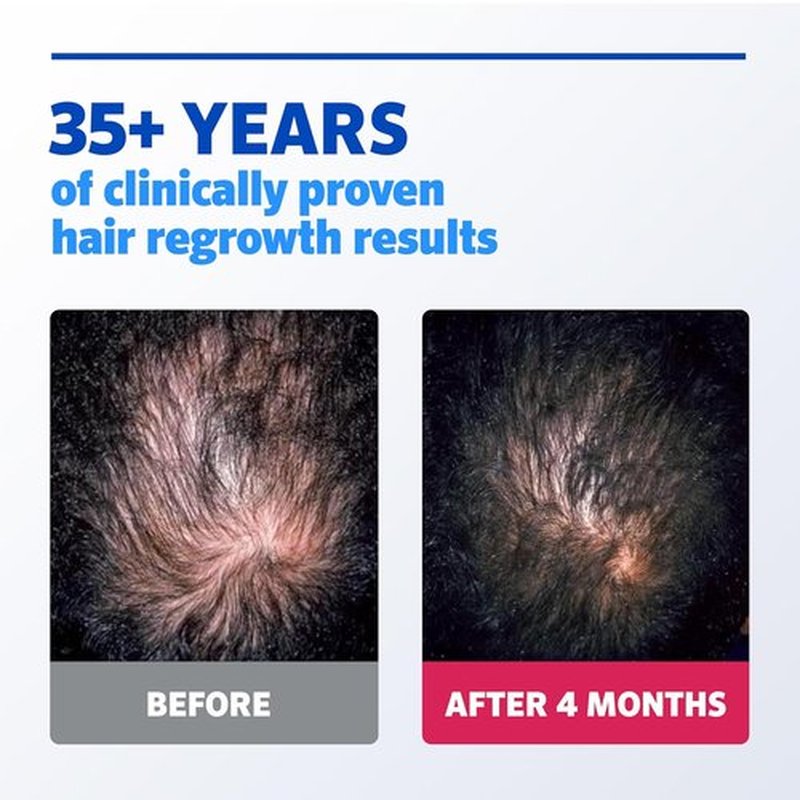 Regine Switzerland Men’s Rogaine Extra Strength Minoxidil - Clinically Proven Hair Regrowth Solution | 3 Bottles, 5% Formula