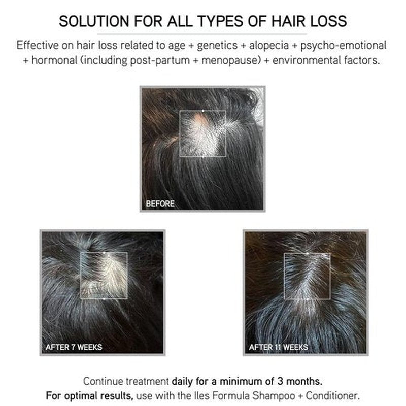 ILES FORMULA Scalp & Hair Rejuvenating Booster - Non-Greasy Serum for Thicker, Stronger Hair | Natural & Fast-Absorbing