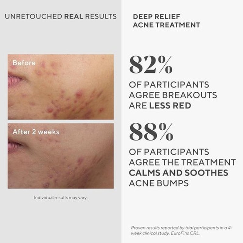 Murad Acne Treatment Combo | Deep Relief Treatment & Clarifying Cleanser with Salicylic Acid - 2-Piece Set