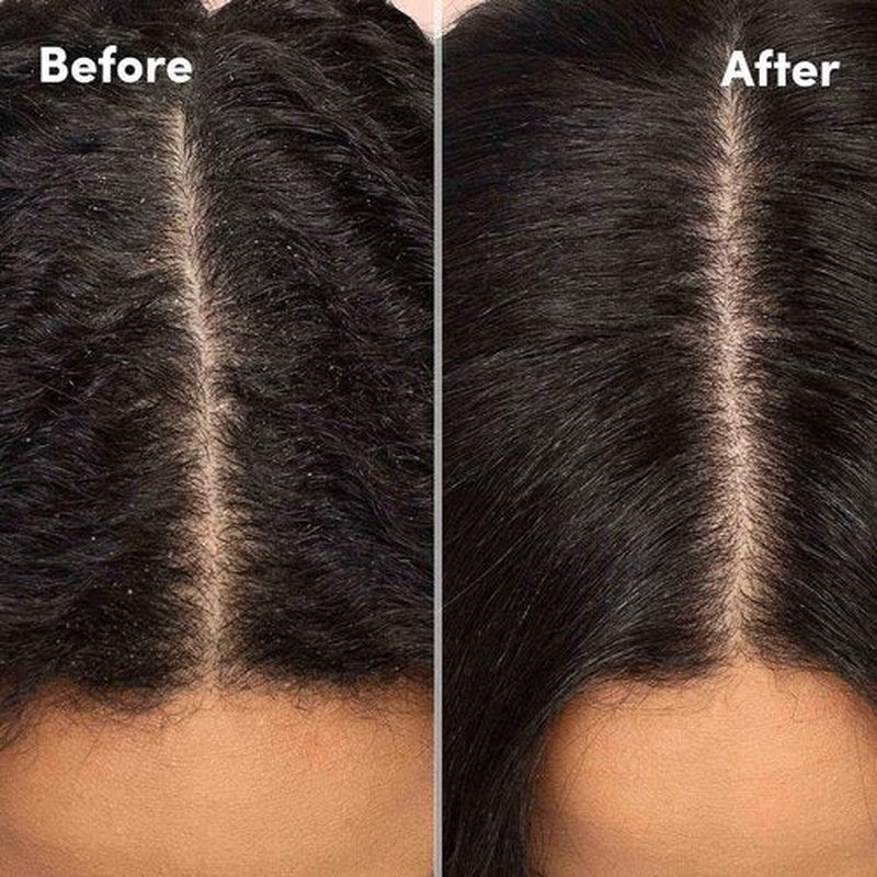 MIZANI Scalp Care Dandruff Shampoo - Deep Cleansing for Curly Hair & Scalp Health