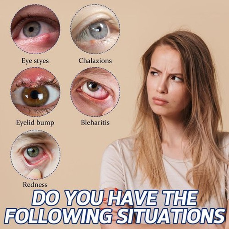 Stye Eye Treatment, Stye Eye Drops, Chalazion Remover, Eye Serum for Styes, Chalazion and Blepharitis Treatment, with Natural Plant-based Formula, 1 Fl Oz