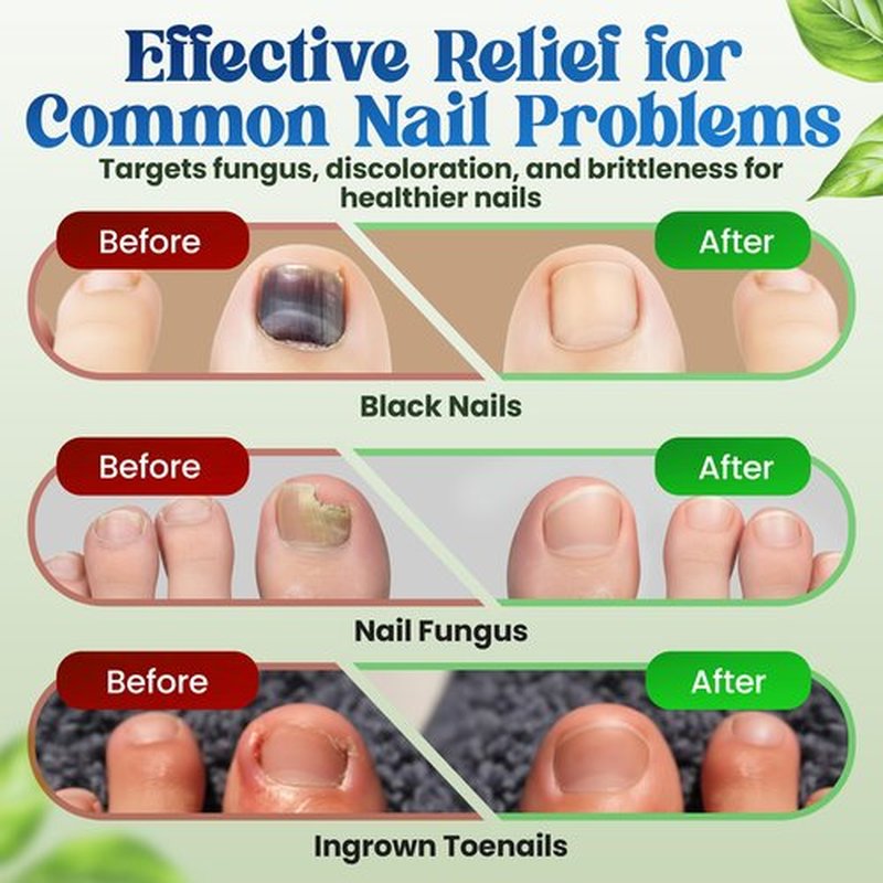 Premium Fungal Nail Patches Toe Nail Care Extra Fungus Strength 21 Pcs Nighttime Repair Damaged Treatment Toenail ingrown Nails 8 Hour Safe Sensitive gift for Women Men .(21 Count)