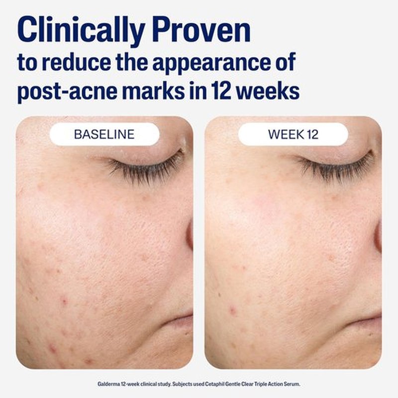 CETAPHIL Gentle Clear Post-Acne Serum - Oil-Free Retinol Alternative for Sensitive Skin | 1 Fl Oz, Bakuchiol