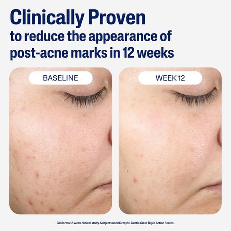 CETAPHIL Gentle Clear Repairing Post-Acne Serum, Retinol Alternative, Oil Free Serum for Sensitive Skin, 1 Fl Oz, Bakuchiol, Improves Skin Tone & Post-acne Marks, Dermatologist Recommended Brand