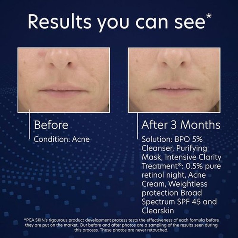 PCA SKIN 5% Benzoyl Peroxide Face Wash - Foaming Acne Cleanser for Oily Skin | 7.0 Oz Bottle