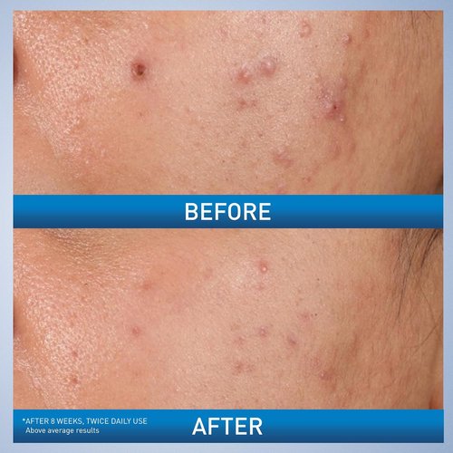 CeraVe Acne Control Gel - 2% Salicylic Acid Treatment with Glycolic & Lactic Acids | 1.35 Fl Oz