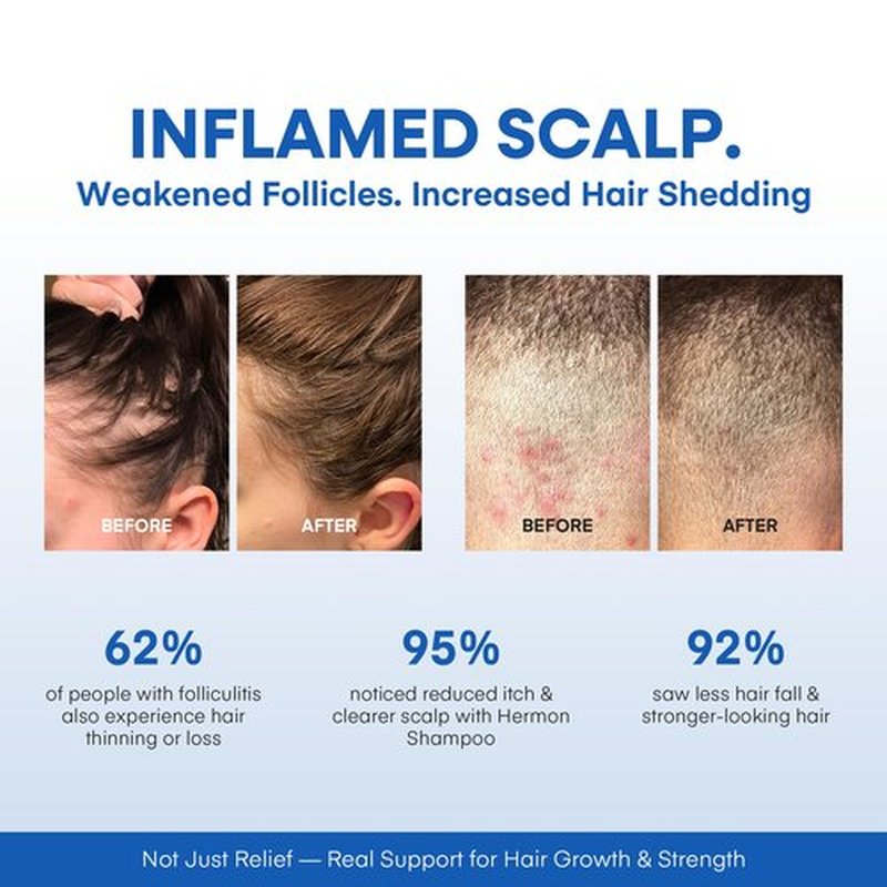 Hermon Folliculitis Shampoo for Itchy Scalp: Psoriasis, Dandruff & Seborrheic Dermatitis & Biotin – Soothes | Exfoliates | Reactivates Follicles
