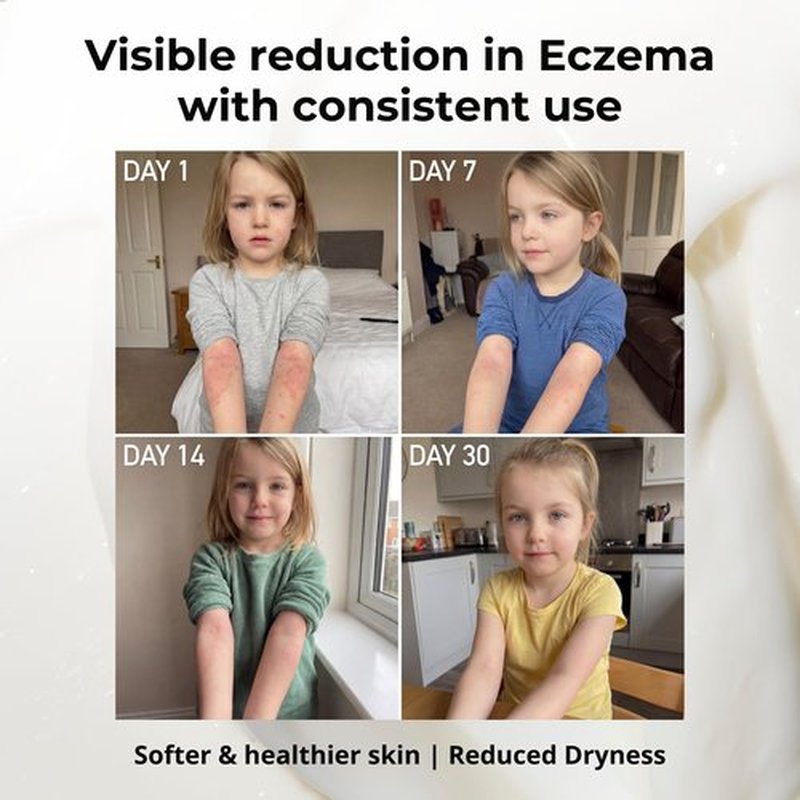 Sven's Island Miracle Manuka Cream (8.8oz) | Natural Steroid-Free Eczema Cream & Face Moisturizer | Dermat Approved | With Manuka Leaf Oil | For Dry Skin, Babies & Adults | Made in New Zealand