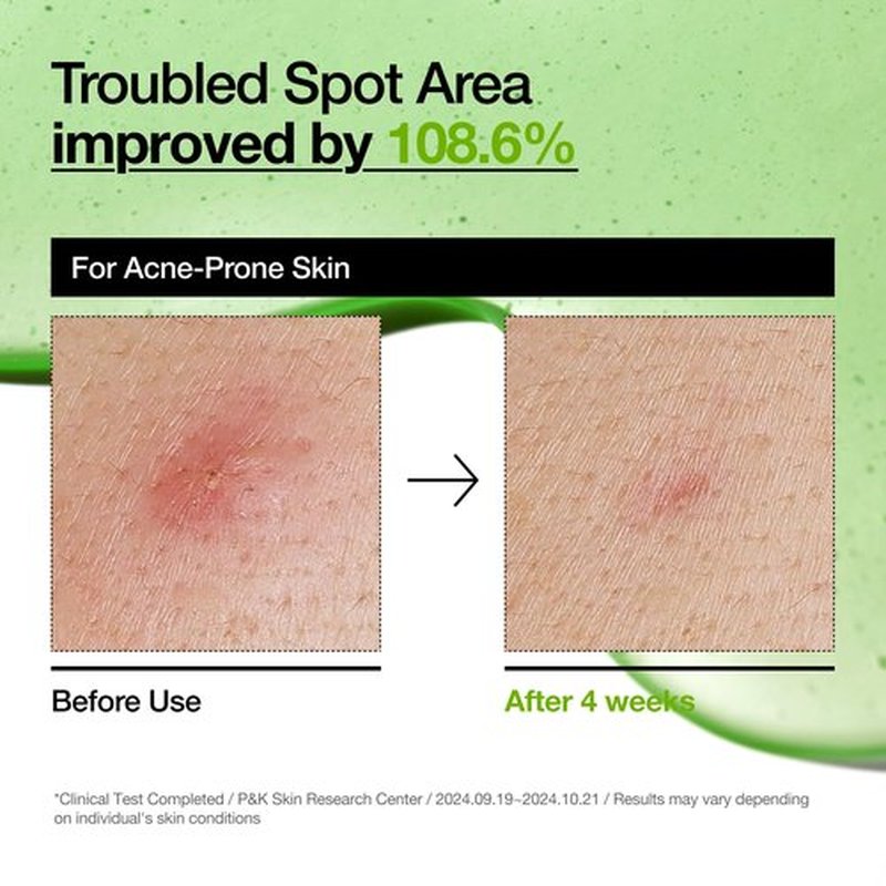 Anua Azelaic Acid 10 Hyaluron Redness Soothing Serum, Facial Serum for Blemish-Prone & Sensitive Skin, Lightweight & Hydrating Blemish Care, Hyaluronic Acid, Korean Skincare, 1.01 fl oz.