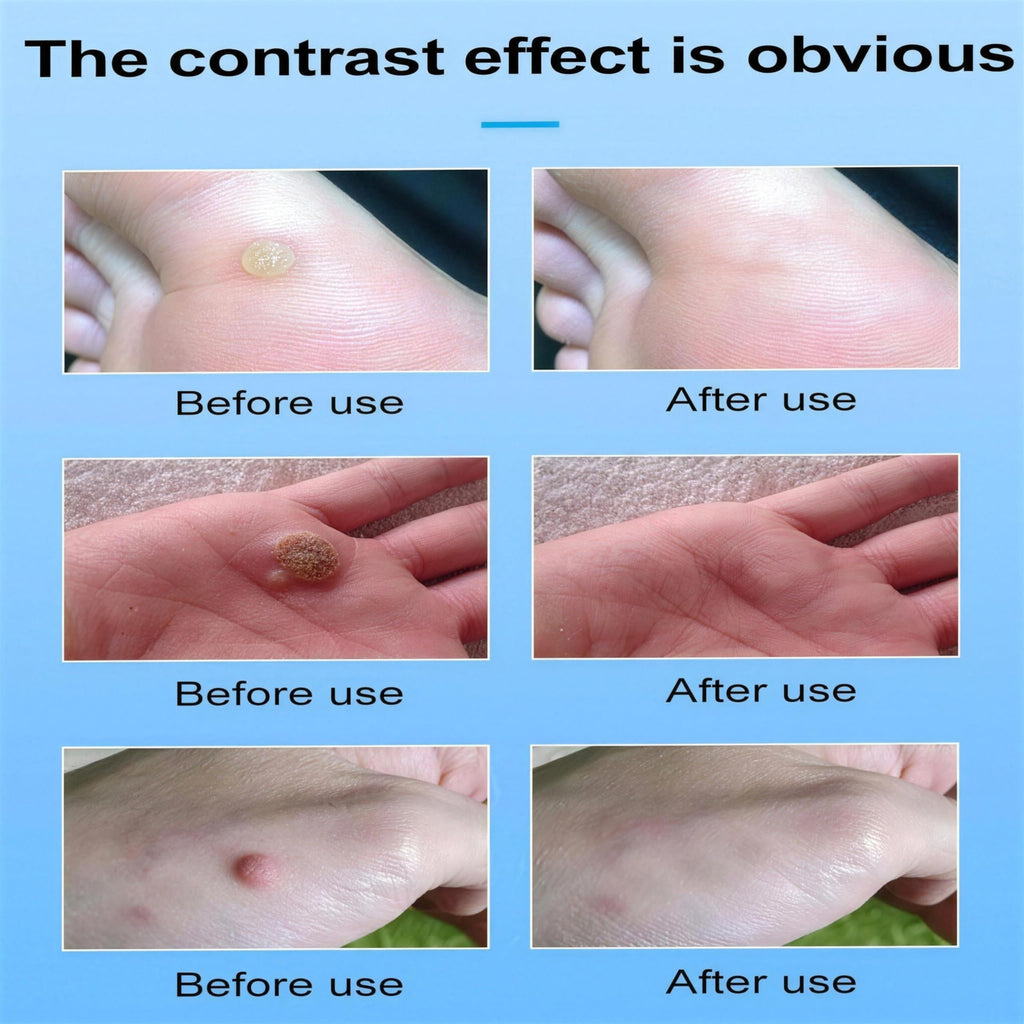 Befada Fast Acting Salicylic Acid Wart Remover Pen for Hands, Feet & Body – Gentle Formula with Brush for Plantar, Common and Flat Warts – Travel Size (0.085 fl oz/4ml)