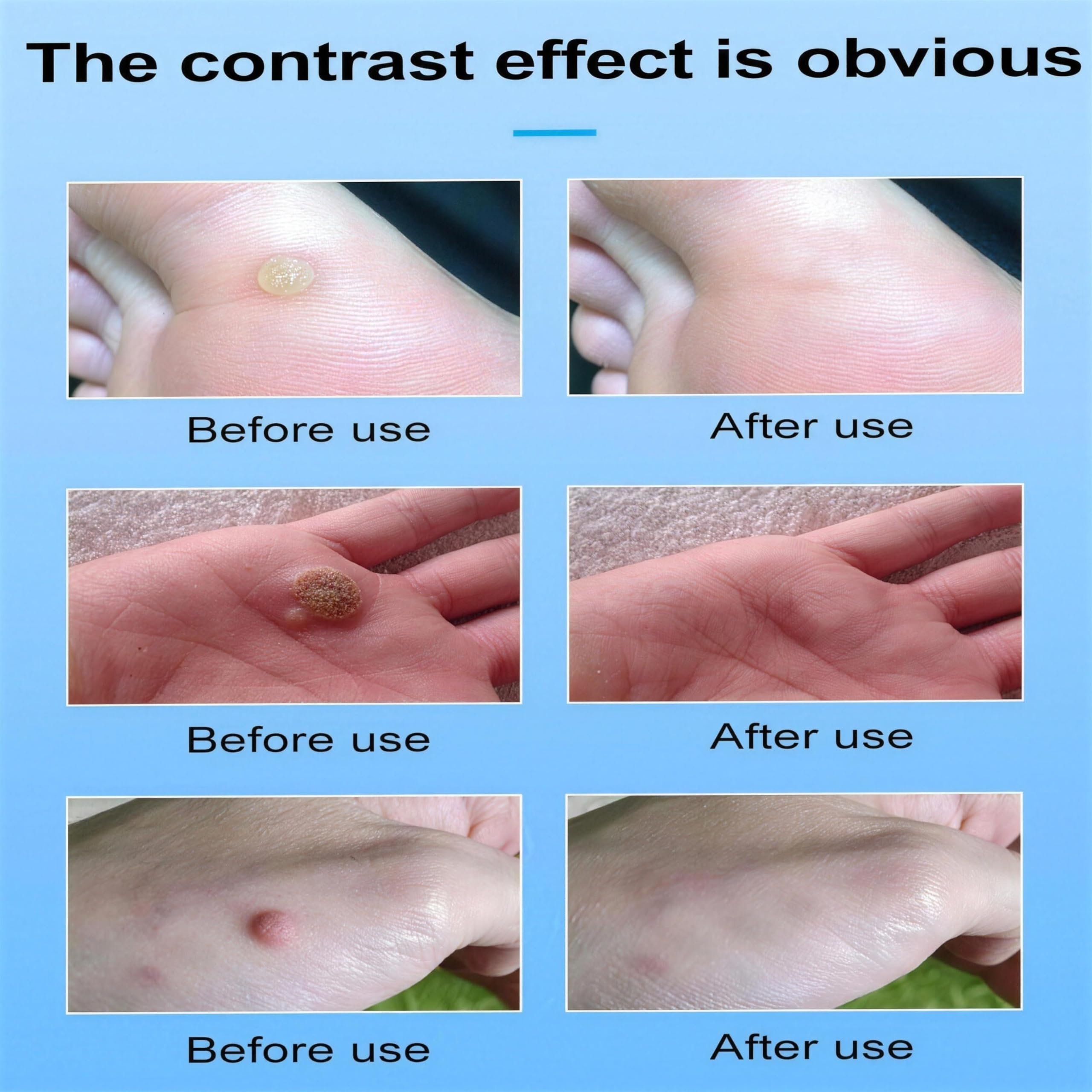 Befada Fast Acting Salicylic Acid Wart Remover Pen for Hands, Feet & Body – Gentle Formula with Brush for Plantar, Common and Flat Warts – Travel Size (0.085 fl oz/4ml)