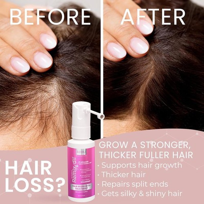 Minoxidil 2% Hair Regrowth Spray for Women - Clinically Proven Thicker & Fuller Solution | 60 ml
