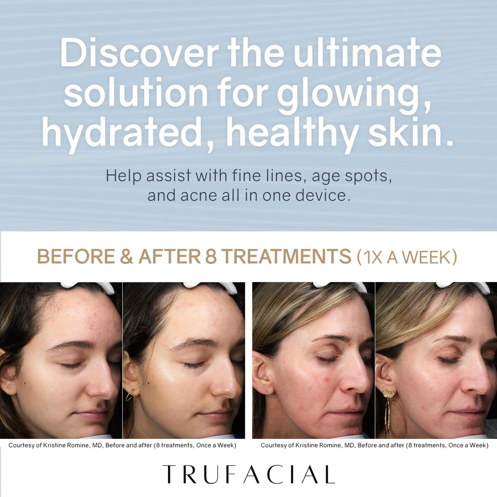 Trufacial-at-Home 3-Step Professional Facial Device – Diamond Microdermabrasion, Activation Massage & 0.25mm Microneedling Roller with Brightening Serums for Radiant, Smoother-Looking Skin