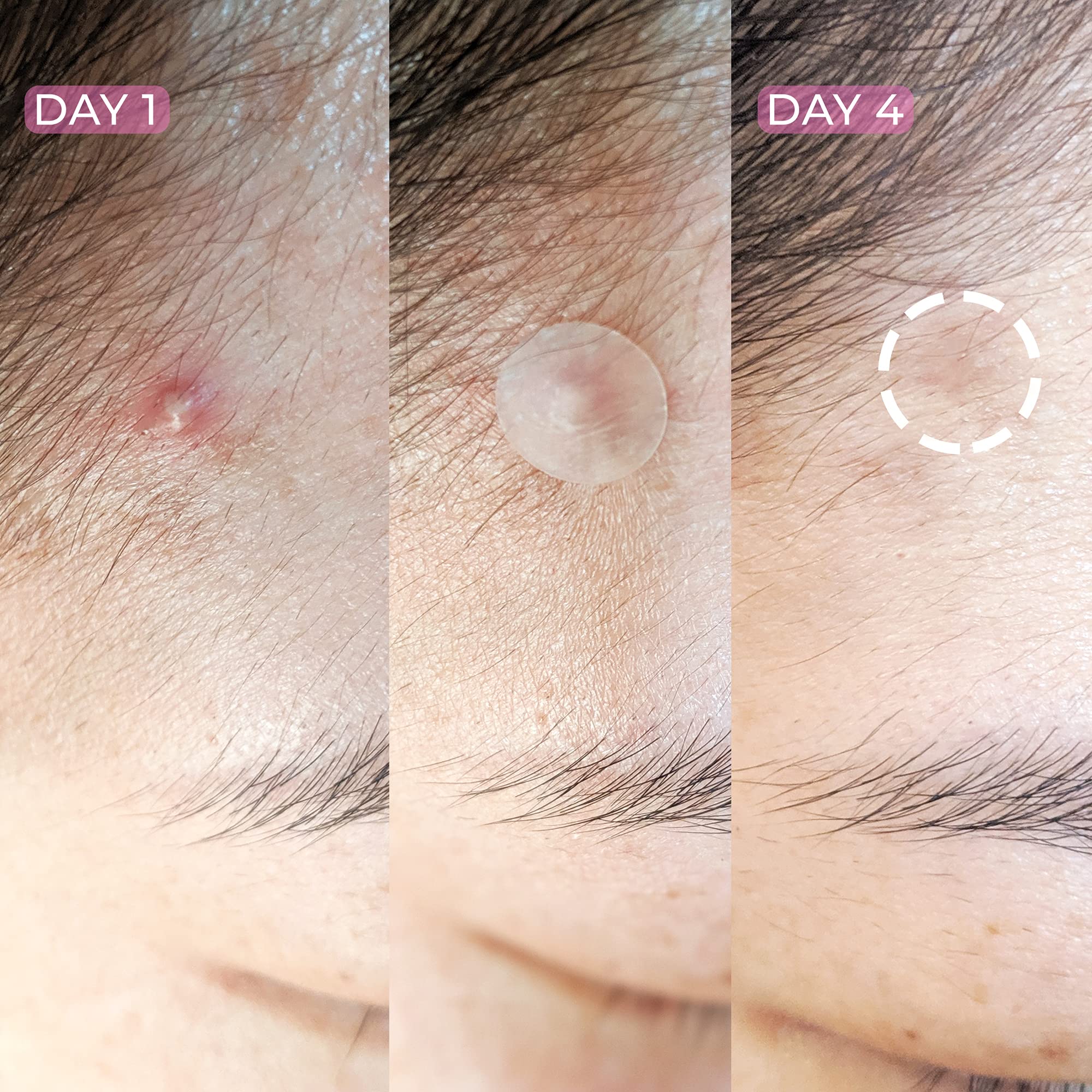 HANHOO Blemish and Custom Patch Duo | Hydrocolloid Patches for Surface Spots and Clusters | 72 Total Patches + 2 Custom Sheets