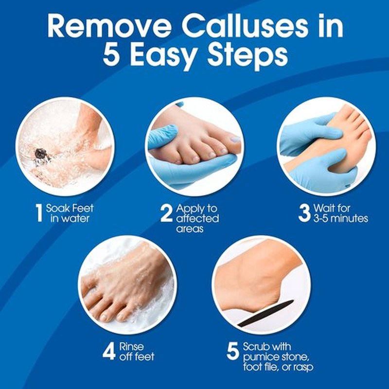 DeEnti Callus Remover Gel - Extra Strength 8oz for Dry Skin & Cracked Heels | Salon-Grade Foot Care