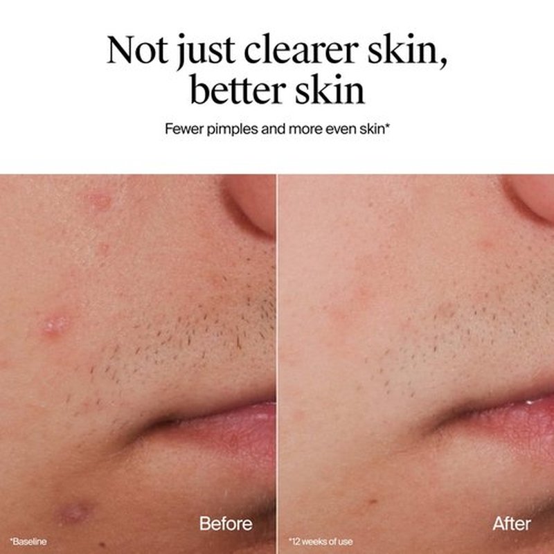 Neutrogena Oil-Free Acne Face Wash, Fragrance Free, Sensitive Skin Facial Cleanser with 2% Salicylic Acid Acne Treatment for Face, 9.1 Fl Oz