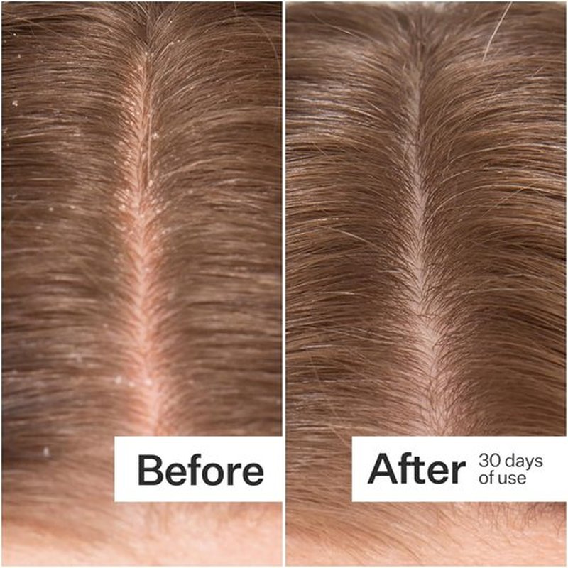 ACT+ ACRE Microbiome Cooling Scalp Serum - Instant Relief for Dry, Itchy Scalp - Natural Vegan Formula, 2.2 fl oz