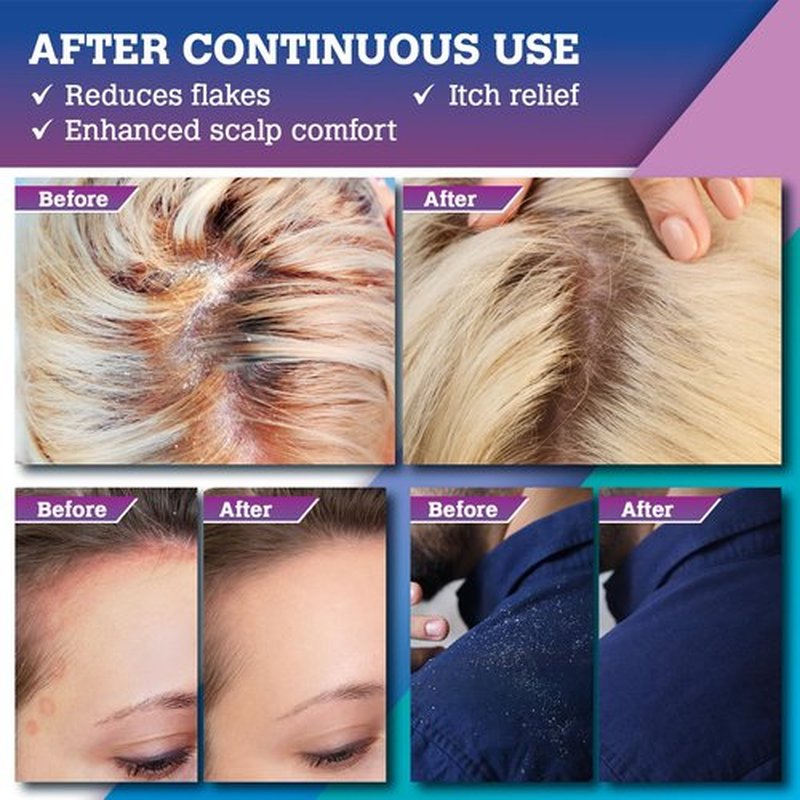 Psoriasis & Seborrheic Dermatitis Antifungal Shampoo: Folliculitis Shampoo, Anti-Dandruff Cleanser for Scalp Acne, Itchy, Redness-Prone Scalp – with Salicylic Acid, Rice Water & Rosemary Oil 9.47 FLOZ