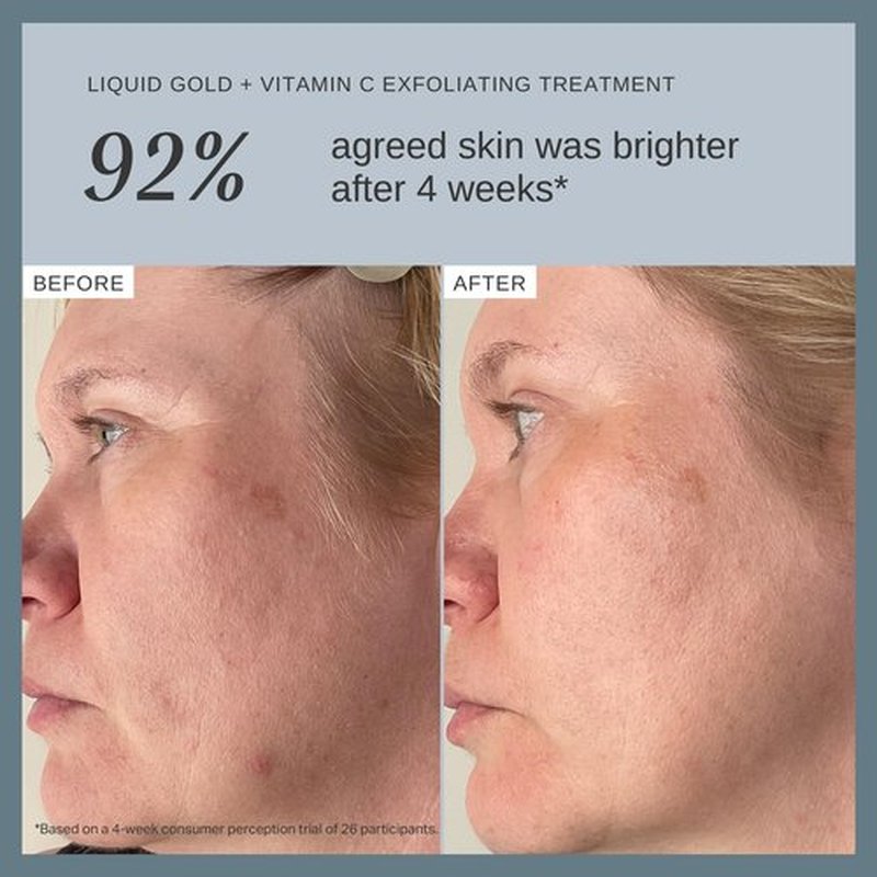 Alpha-H Liquid Gold + Vitamin C Exfoliating Treatment 100ml - Brighten, Even Tone, Smooth Texture, Reduce Appearance of Fine Lines - At-Home Skin Renewal for All Skin Types
