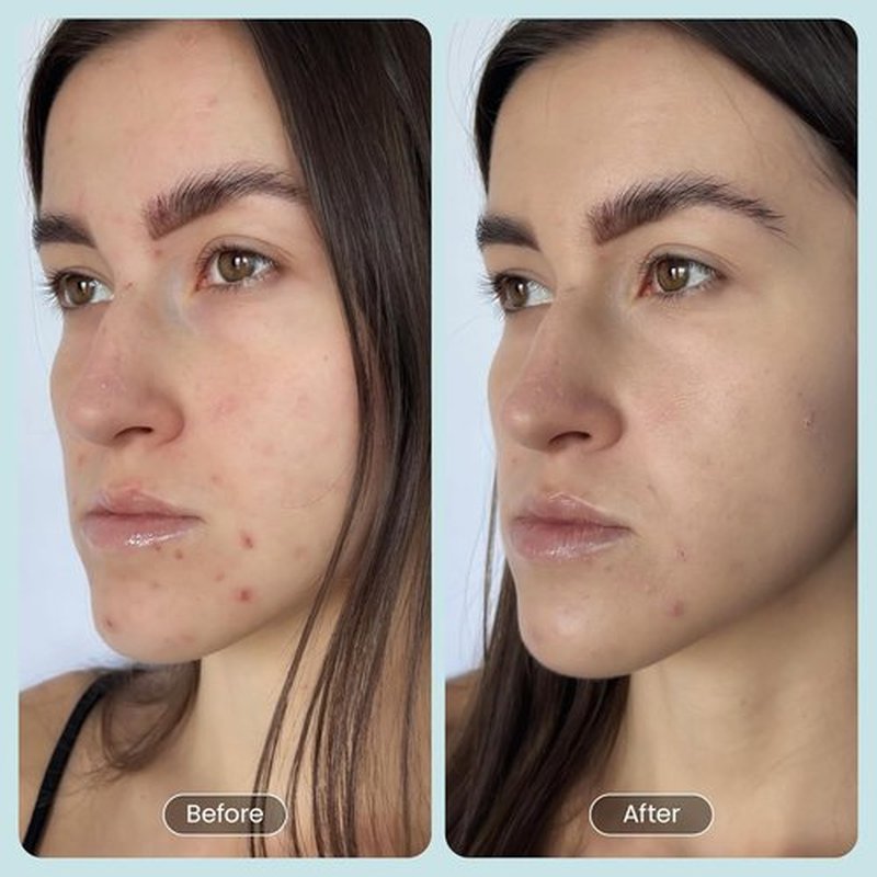 30 Day Miracle BHA 20% Peeling Solution - Clinical Strength Exfoliant for Clogged Pores & Wrinkles | 1oz