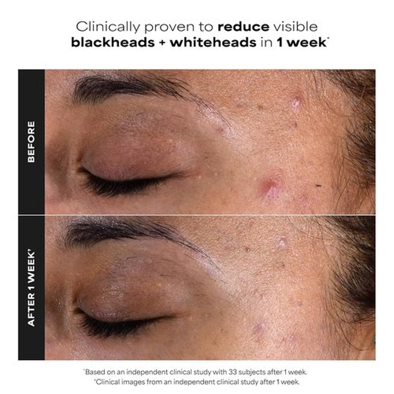 Paula's Choice SKIN PERFECTING 2% BHA Exfoliating Pads - Clear Blackheads & Minimize Pores, 60 Count