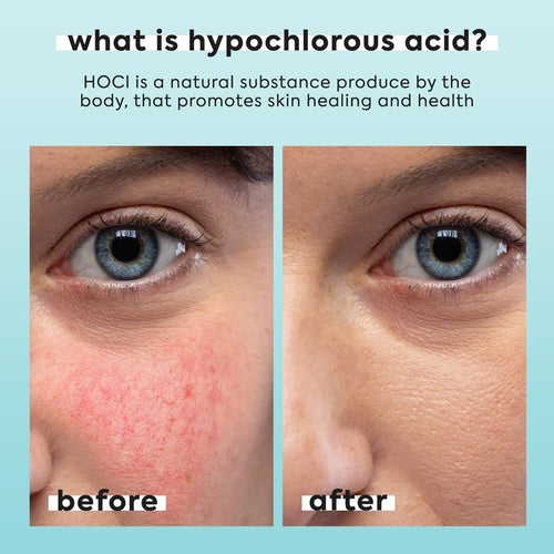 2 Pack Hypochlorous Acid Spray for Face & Body - 2 x 3.4 fl oz - Helps Reduce Redness and Breakouts - Multi-Purpose Travel Size Hypochlorous Spray - Topical Facial Skin Repair - pH-Balancing Toner