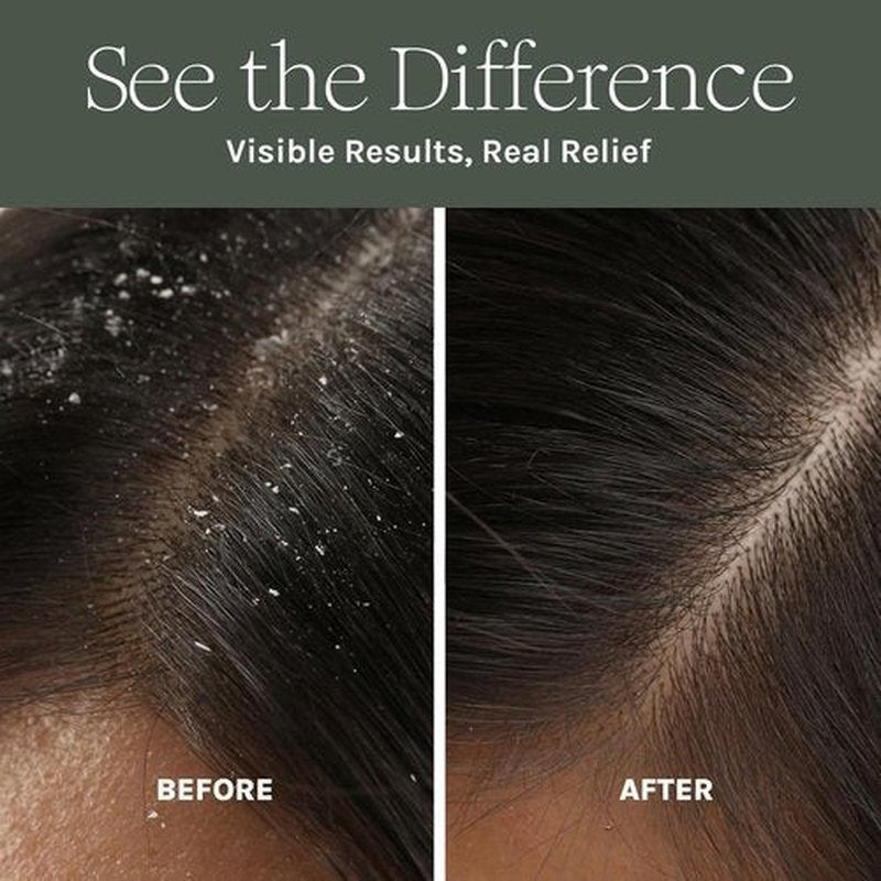 Antifungal Antibacterial Scalp Mask by [Brand Name] - Boost Hair Growth with Natural Detox Ingredients - Nourishing Aloe, Neem & Rosemary