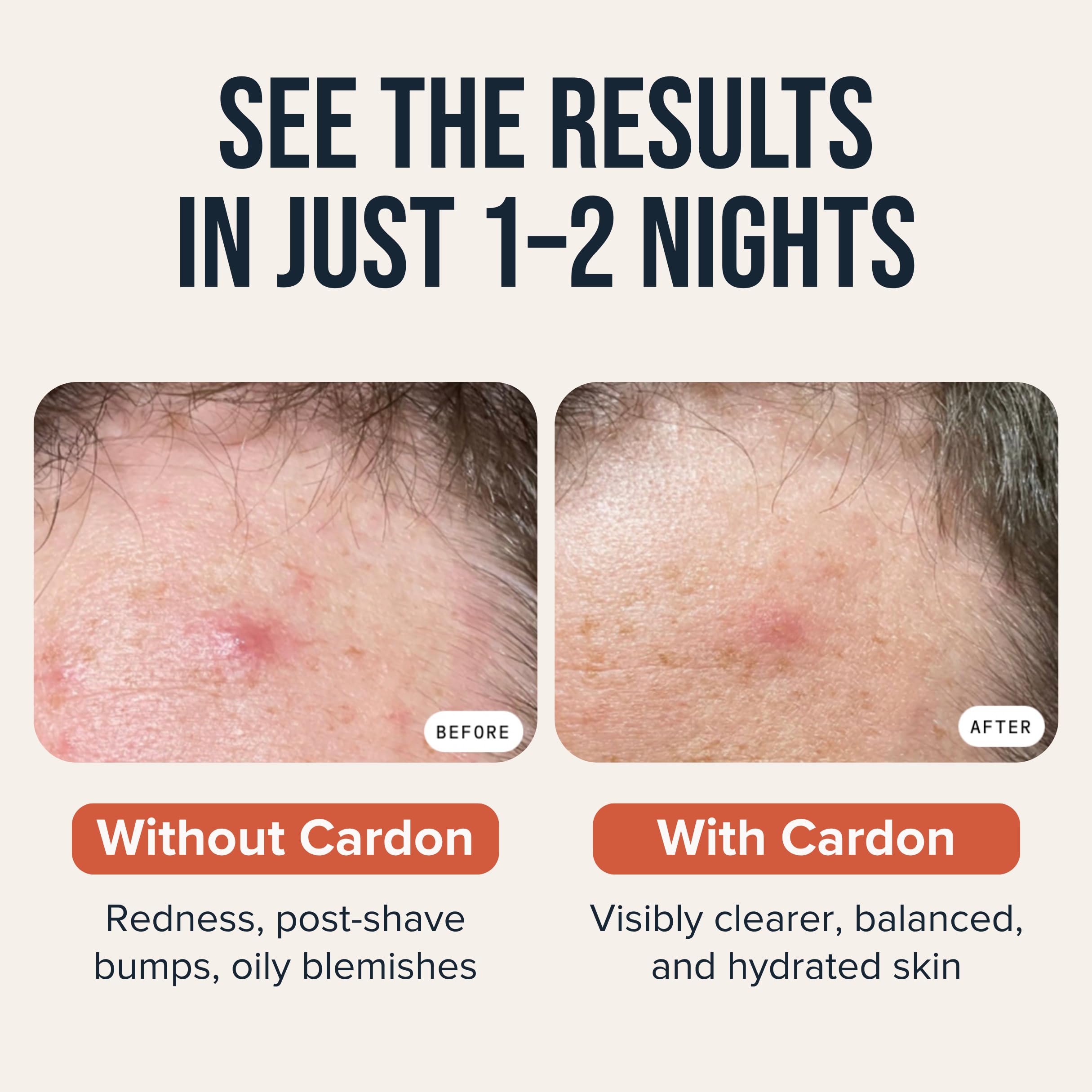 Cardon Microneedle Patches - Microdart Acne Patch with Salicylic Acid, Niacinamide & Hyaluronic Acid - Korean Pimple Patches to treat Zits, Blackheads, Blemishes, Razor Bumps, Ingrown Hair - (9 count)