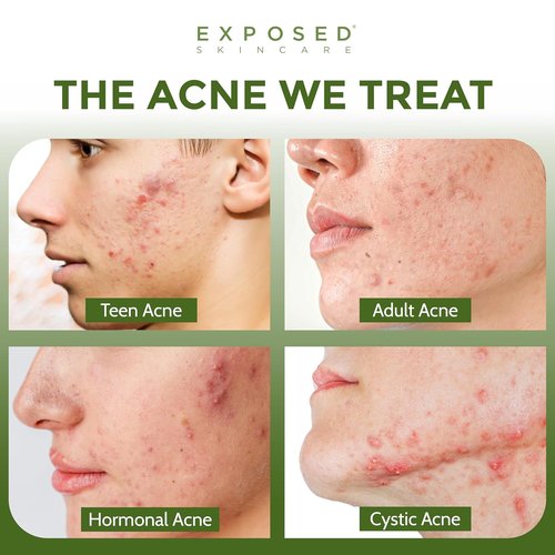 Exposed Skin Care Acne Treatment Mask - 3% Sulfur & Activated Charcoal for Oil Control | Natural & Cruelty-Free