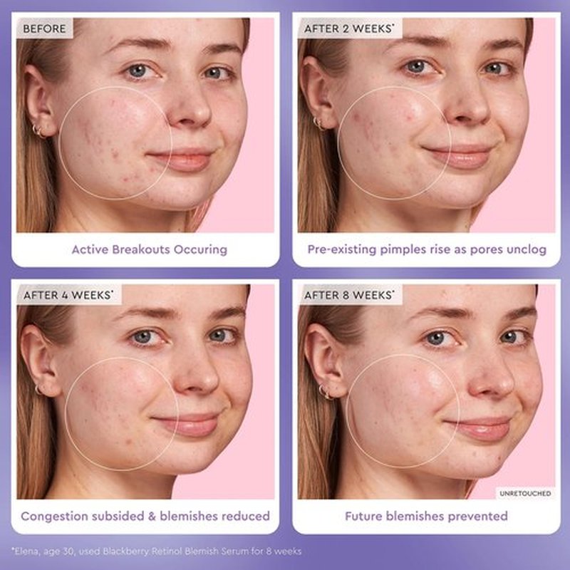 Glow Recipe Gentle Blackberry Retinol Serum, Korean Retinol Night Serum for Sensitive Skin, Triple Retinoids + Glycerin, Clarifying for Blemishes, Smooths Texture and Fine Lines (30ml)