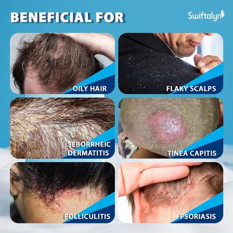 Swiftalyn Antifungal Shampoo for Seborrheic Dermatitis & Folliculitis: Psoriasis, Dandruff & Scalp Ance Shampoo for Men & Women – Soothes Itchy, Flaky Scalp – Sulfate-Free Formula