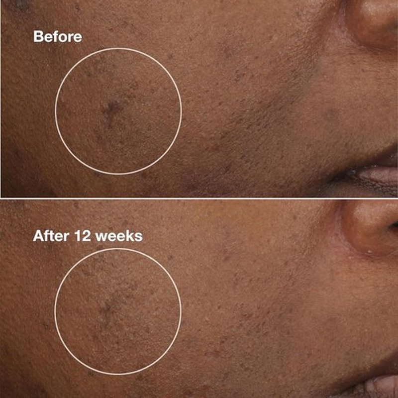Clinique Even Better Clinical Brightening Moisturizer - Hydrating Dark Spot Reducer with Salicylic Acid & Vitamin C