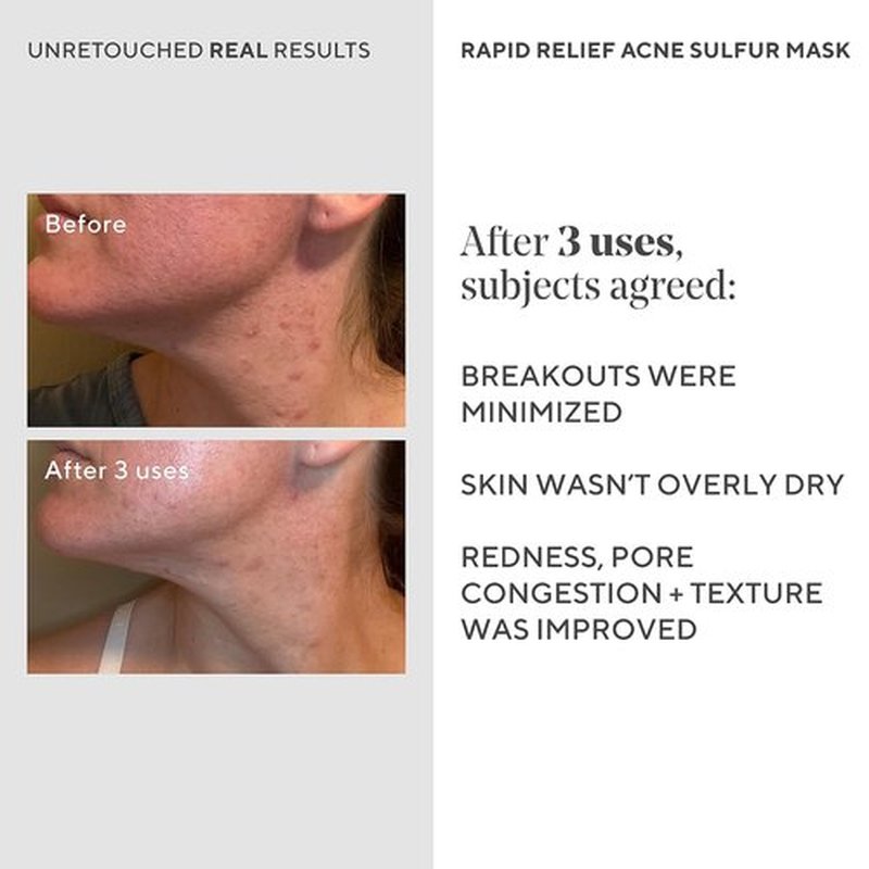 Murad Rapid Relief Acne Sulfur Mask - Clay Mask with Salicylic Acid & 5% Sulfur | Reduces Breakouts & Unclogs Pores - 2.5 Fl Oz