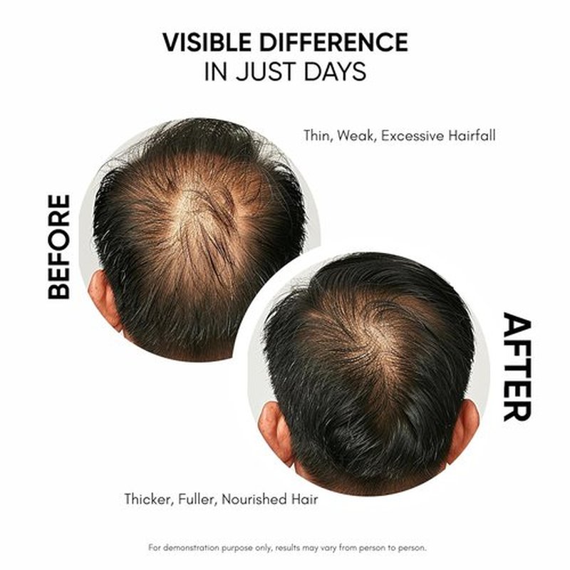Masofta Hair Growth Serum - Promote Hair Growth & Reduce Hair Fall | 50 ml | For Men & Women