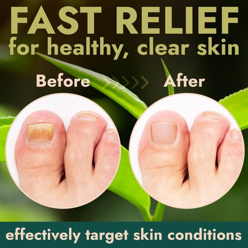 Terramed Just Think Comfort Toenail Fungus Antifungal Foot Cream, Antifungal Foot Treatment NDC Code(s): 83004-025